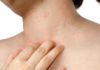 what causes eczema