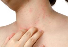 what causes eczema