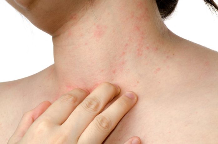 what causes eczema