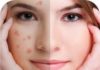 Home remedies for blemishes