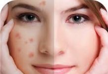 Home remedies for blemishes