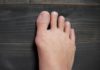 How to get rid of bunions?