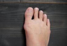 How to get rid of bunions?
