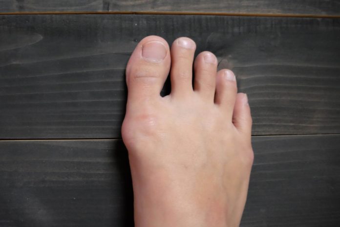 How to get rid of bunions?