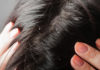 get rid of dandruff permanently and naturally