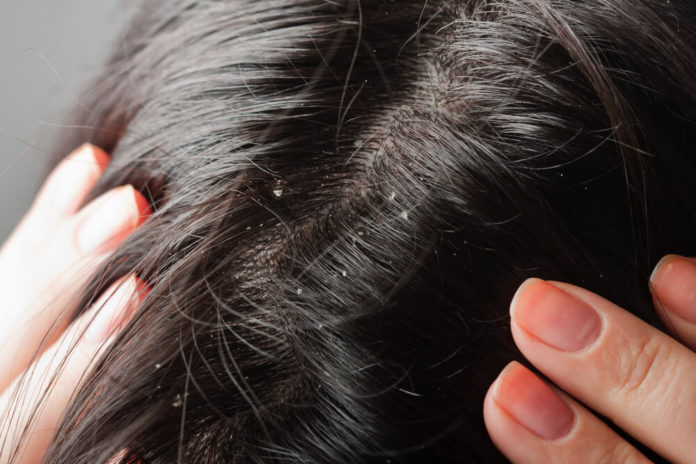 get rid of dandruff permanently and naturally