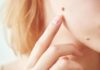 How to remove moles naturally