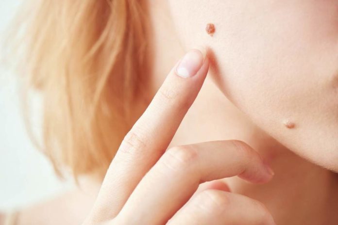 How to remove moles naturally