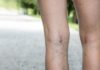 spider veins