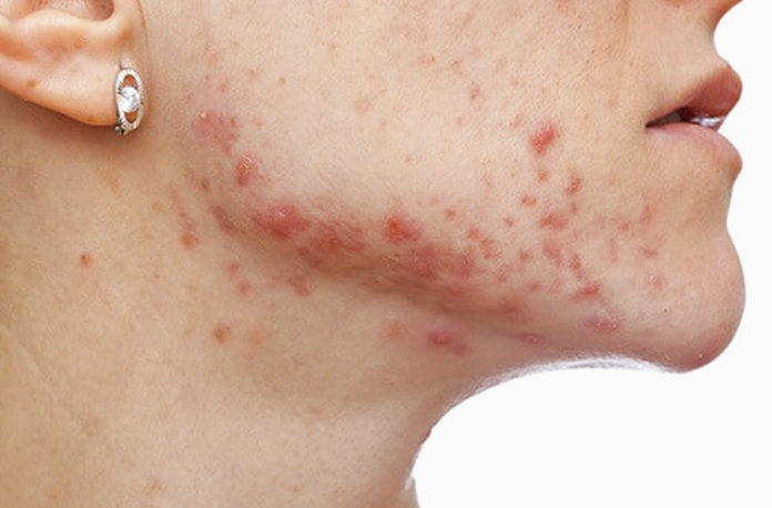 what is fungal acne
