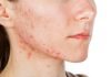 what is hormonal acne