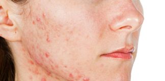 what is hormonal acne