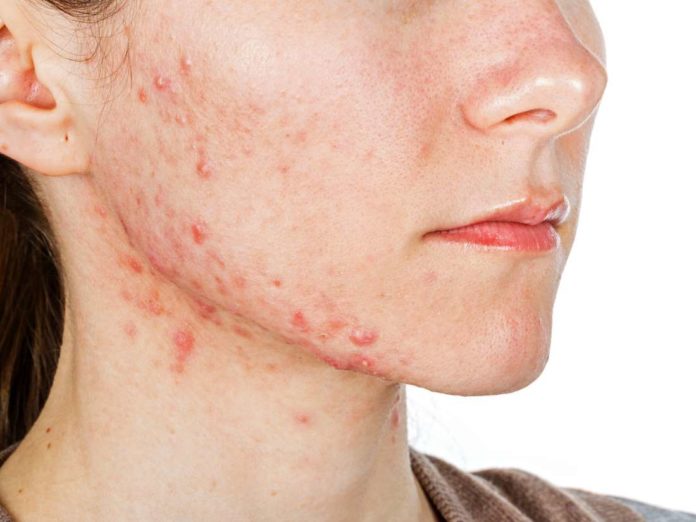 what is hormonal acne