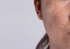 - does noxzema anti blemish pads work