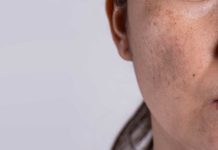 - does noxzema anti blemish pads work