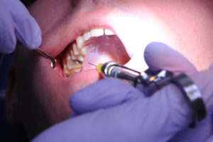 gum line cavity