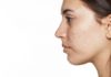 how to get rid of cystic acne