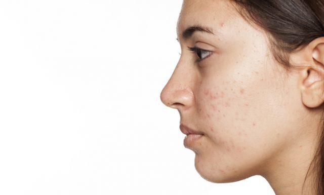 how to get rid of cystic acne