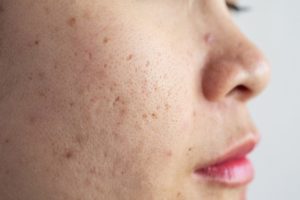 What is Cystic Acne