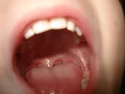 causes of toothache