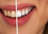 What is Cosmetic Dentistry