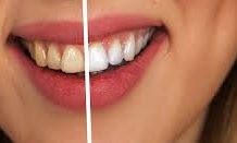 What is Cosmetic Dentistry