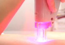 What is Laser Hair Removal