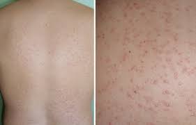 causes of fungal acne