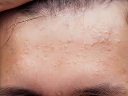 Symptoms of fungal acne