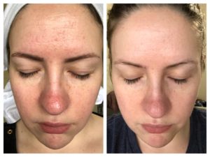 treatments of fungal acne