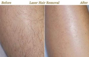 Side effects of laser hair removal
