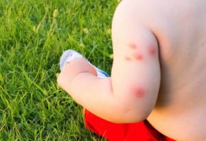 bedbug bites on kids