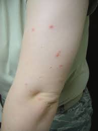 bed bugs bite