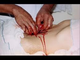 psychic surgery