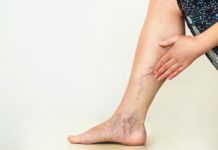 spider veins