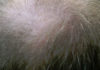 hair-growth