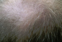 hair-growth
