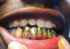 permanent gold teeth