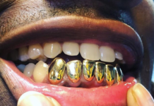 permanent gold teeth