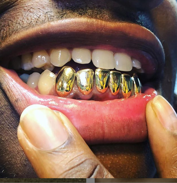 How Much Does Permanent Gold Teeth Cost A Best Fashion