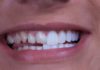 how long do veneers last