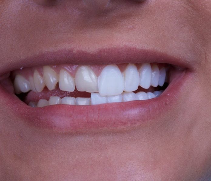 how long do veneers last