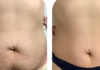 stretch mark tattoos