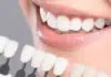 how long does teeth whitening last