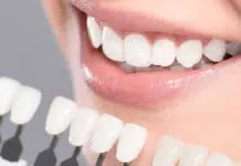how long does teeth whitening last