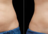 Coolsculpting abdomen cost