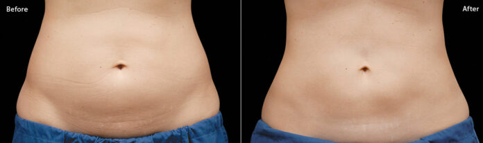 Coolsculpting abdomen cost