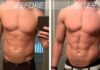 All About Gynecomastia Surgery!