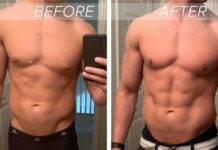All About Gynecomastia Surgery!