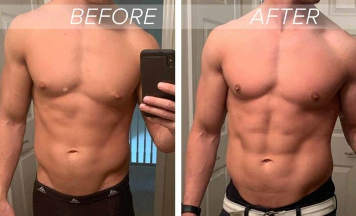 All About Gynecomastia Surgery!